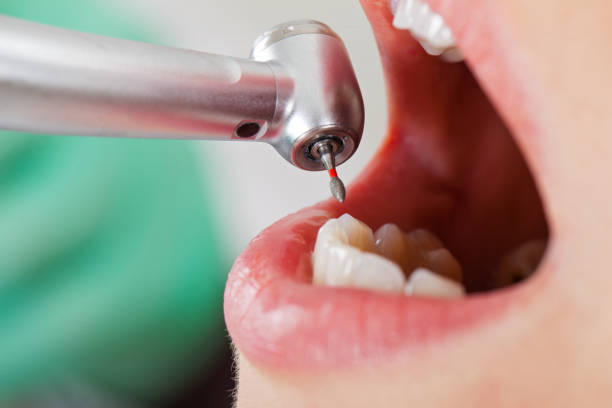 Best Broken or Chipped Tooth Repair in Fruitridge Pocket, CA